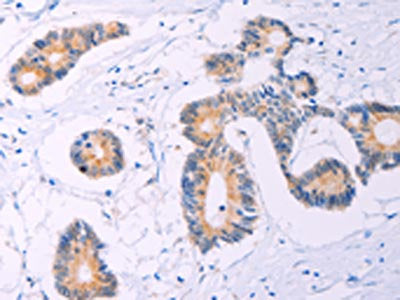 The image on the left is immunohistochemistry of paraffin-embedded Human colon cancer tissue using CSB-PA942397(ADCY5 Antibody) at dilution 1/30, on the right is treated with synthetic peptide. (Original magnification: ×200)