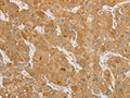 The image is immunohistochemistry of paraffin-embedded Human liver cancer tissue using CSB-PA942456(NGF Antibody) at dilution 1/50. (Original magnification: ×200)