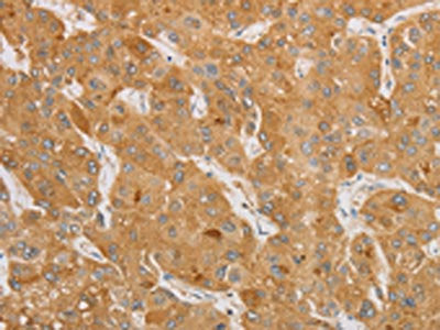 The image is immunohistochemistry of paraffin-embedded Human liver cancer tissue using CSB-PA942456(NGF Antibody) at dilution 1/50. (Original magnification: ×200)