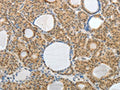 The image on the left is immunohistochemistry of paraffin-embedded Human thyroid cancer tissue using CSB-PA942495(AKAP6 Antibody) at dilution 1/30, on the right is treated with synthetic peptide. (Original magnification: ×200)
