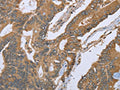 The image on the left is immunohistochemistry of paraffin-embedded Human colon cancer tissue using CSB-PA942640(IL1RN Antibody) at dilution 1/25, on the right is treated with fusion protein. (Original magnification: ×200)