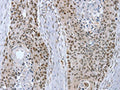 The image on the left is immunohistochemistry of paraffin-embedded Human esophagus cancer tissue using CSB-PA942697(RNF20 Antibody) at dilution 1/20, on the right is treated with fusion protein. (Original magnification: ×200)