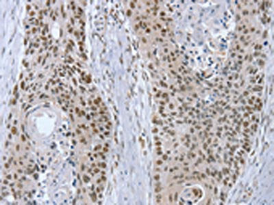 The image on the left is immunohistochemistry of paraffin-embedded Human esophagus cancer tissue using CSB-PA942697(RNF20 Antibody) at dilution 1/20, on the right is treated with fusion protein. (Original magnification: ×200)
