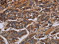 The image on the left is immunohistochemistry of paraffin-embedded Human breast cancer tissue using CSB-PA942745(KCNQ1 Antibody) at dilution 1/50, on the right is treated with fusion protein. (Original magnification: ×200)