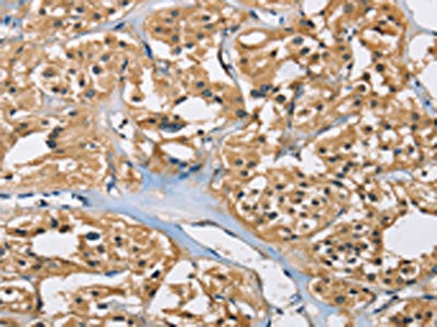 The image on the left is immunohistochemistry of paraffin-embedded Human thyroid cancer tissue using CSB-PA943107(PPP3CA Antibody) at dilution 1/40, on the right is treated with fusion protein. (Original magnification: ×200)