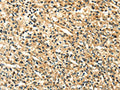 The image on the left is immunohistochemistry of paraffin-embedded Human prostate cancer tissue using CSB-PA943186(LILRB2 Antibody) at dilution 1/20, on the right is treated with fusion protein. (Original magnification: ×200)