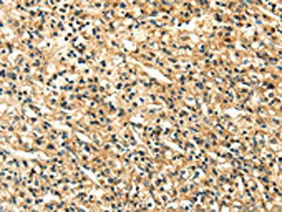 The image on the left is immunohistochemistry of paraffin-embedded Human prostate cancer tissue using CSB-PA943186(LILRB2 Antibody) at dilution 1/20, on the right is treated with fusion protein. (Original magnification: ×200)