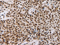 The image on the left is immunohistochemistry of paraffin-embedded Human esophagus cancer tissue using CSB-PA943275(AKAP8 Antibody) at dilution 1/30, on the right is treated with synthetic peptide. (Original magnification: ×200)