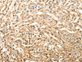 The image on the left is immunohistochemistry of paraffin-embedded Human lung cancer tissue using CSB-PA943707(SLC25A11 Antibody) at dilution 1/40, on the right is treated with fusion protein. (Original magnification: ×200)