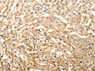 The image on the left is immunohistochemistry of paraffin-embedded Human lung cancer tissue using CSB-PA943707(SLC25A11 Antibody) at dilution 1/40, on the right is treated with fusion protein. (Original magnification: ×200)