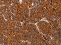 The image on the left is immunohistochemistry of paraffin-embedded Human liver cancer tissue using CSB-PA944210(GC Antibody) at dilution 1/30, on the right is treated with fusion protein. (Original magnification: ×200)