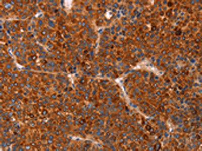 The image on the left is immunohistochemistry of paraffin-embedded Human liver cancer tissue using CSB-PA944210(GC Antibody) at dilution 1/30, on the right is treated with fusion protein. (Original magnification: ×200)
