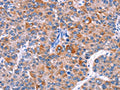 The image on the left is immunohistochemistry of paraffin-embedded Human liver cancer tissue using CSB-PA944356(ELP2 Antibody) at dilution 1/40, on the right is treated with fusion protein. (Original magnification: ×200)