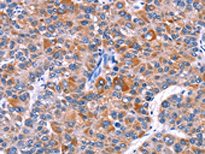 The image on the left is immunohistochemistry of paraffin-embedded Human liver cancer tissue using CSB-PA944356(ELP2 Antibody) at dilution 1/40, on the right is treated with fusion protein. (Original magnification: ×200)