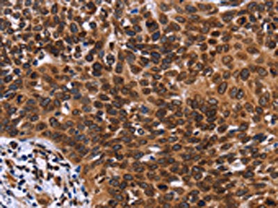 The image on the left is immunohistochemistry of paraffin-embedded Human cervical cancer tissue using CSB-PA944715(LMNB1 Antibody) at dilution 1/60, on the right is treated with fusion protein. (Original magnification: ×200)