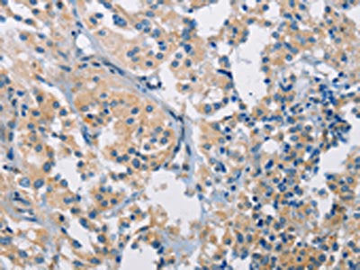 The image on the left is immunohistochemistry of paraffin-embedded Human thyroid cancer tissue using CSB-PA944824(PDCD1LG2 Antibody) at dilution 1/40, on the right is treated with fusion protein. (Original magnification: ×200)