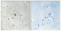 Immunohistochemical analysis of paraffin-embedded human brain tissue using IGF1R (Phospho-Tyr1346) antibody (left)or the same antibody preincubated with blocking peptide (right).