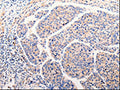 The image on the left is immunohistochemistry of paraffin-embedded Human liver cancer tissue using CSB-PA945457(CLEC10A Antibody) at dilution 1/25, on the right is treated with fusion protein. (Original magnification: ×200)