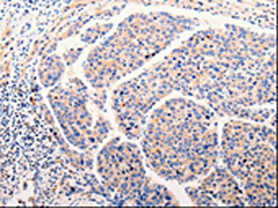 The image on the left is immunohistochemistry of paraffin-embedded Human liver cancer tissue using CSB-PA945457(CLEC10A Antibody) at dilution 1/25, on the right is treated with fusion protein. (Original magnification: ×200)