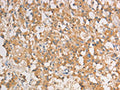 The image on the left is immunohistochemistry of paraffin-embedded Human thyroid cancer tissue using CSB-PA945784(ART3 Antibody) at dilution 1/40, on the right is treated with fusion protein. (Original magnification: ×200)