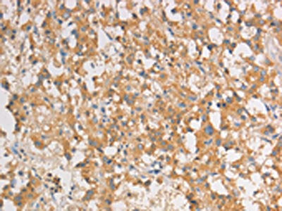 The image on the left is immunohistochemistry of paraffin-embedded Human thyroid cancer tissue using CSB-PA945784(ART3 Antibody) at dilution 1/40, on the right is treated with fusion protein. (Original magnification: ×200)