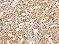 The image on the left is immunohistochemistry of paraffin-embedded Human thyroid cancer tissue using CSB-PA945911(UBQLN1 Antibody) at dilution 1/20, on the right is treated with fusion protein. (Original magnification: ×200)