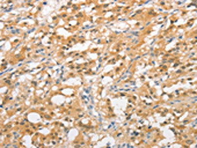 The image on the left is immunohistochemistry of paraffin-embedded Human thyroid cancer tissue using CSB-PA945911(UBQLN1 Antibody) at dilution 1/20, on the right is treated with fusion protein. (Original magnification: ×200)
