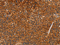The image on the left is immunohistochemistry of paraffin-embedded Human liver cancer tissue using CSB-PA945984(CDK19 Antibody) at dilution 1/70, on the right is treated with synthetic peptide. (Original magnification: X200)