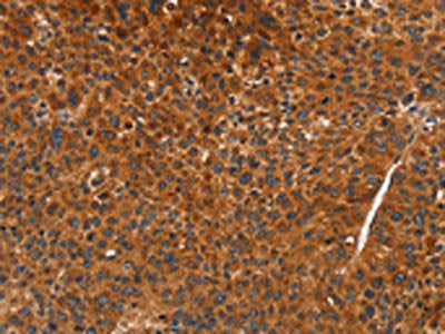 The image on the left is immunohistochemistry of paraffin-embedded Human liver cancer tissue using CSB-PA945984(CDK19 Antibody) at dilution 1/70, on the right is treated with synthetic peptide. (Original magnification: X200)