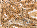 The image on the left is immunohistochemistry of paraffin-embedded Human colon cancer tissue using CSB-PA946457(ADRA1B Antibody) at dilution 1/20, on the right is treated with synthetic peptide. (Original magnification: ×200)