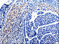 The image on the left is immunohistochemistry of paraffin-embedded Human liver cancer tissue using CSB-PA947265(CDC20 Antibody) at dilution 1/10, on the right is treated with fusion protein. (Original magnification: ×200)