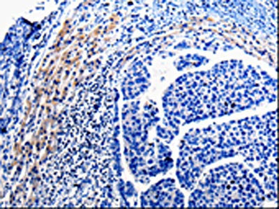 The image on the left is immunohistochemistry of paraffin-embedded Human liver cancer tissue using CSB-PA947265(CDC20 Antibody) at dilution 1/10, on the right is treated with fusion protein. (Original magnification: ×200)