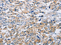 The image on the left is immunohistochemistry of paraffin-embedded Human thyroid cancer tissue using CSB-PA947266(MTMR4 Antibody) at dilution 1/15, on the right is treated with fusion protein. (Original magnification: ×200)
