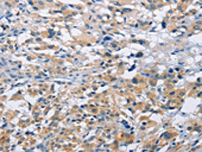 The image on the left is immunohistochemistry of paraffin-embedded Human thyroid cancer tissue using CSB-PA947266(MTMR4 Antibody) at dilution 1/15, on the right is treated with fusion protein. (Original magnification: ×200)