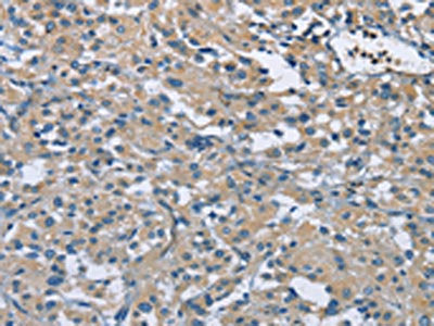 The image on the left is immunohistochemistry of paraffin-embedded Human thyroid cancer tissue using CSB-PA947569(ZMYND11 Antibody) at dilution 1/50, on the right is treated with fusion protein. (Original magnification: ×200)