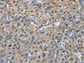 The image on the left is immunohistochemistry of paraffin-embedded Human liver cancer tissue using CSB-PA948042(CAB39L Antibody) at dilution 1/30, on the right is treated with fusion protein. (Original magnification: ×200)
