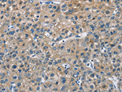 The image on the left is immunohistochemistry of paraffin-embedded Human liver cancer tissue using CSB-PA948042(CAB39L Antibody) at dilution 1/30, on the right is treated with fusion protein. (Original magnification: ×200)