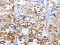 The image on the left is immunohistochemistry of paraffin-embedded Human thyroid cancer tissue using CSB-PA948047(CAPZA3 Antibody) at dilution 1/70, on the right is treated with fusion protein. (Original magnification: ×200)