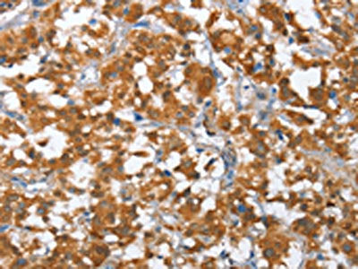The image on the left is immunohistochemistry of paraffin-embedded Human thyroid cancer tissue using CSB-PA948343(TP53BP2 Antibody) at dilution 1/35, on the right is treated with fusion protein. (Original magnification: ×200)