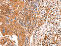 The image on the left is immunohistochemistry of paraffin-embedded Human cervical cancer tissue using CSB-PA948378(ACAD9 Antibody) at dilution 1/10, on the right is treated with fusion protein. (Original magnification: ×200)
