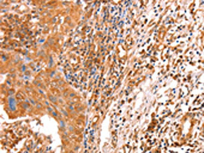 The image on the left is immunohistochemistry of paraffin-embedded Human cervical cancer tissue using CSB-PA948378(ACAD9 Antibody) at dilution 1/10, on the right is treated with fusion protein. (Original magnification: ×200)