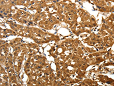 The image on the left is immunohistochemistry of paraffin-embedded Human lung cancer  tissue using CSB-PA948689(PARK7 Antibody) at dilution 1/25, on the right is treated with fusion protein. (Original magnification: ×200)