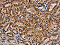The image on the left is immunohistochemistry of paraffin-embedded Human thyroid cancer tissue using CSB-PA948825(RBMX Antibody) at dilution 1/45, on the right is treated with fusion protein. (Original magnification: ×200)