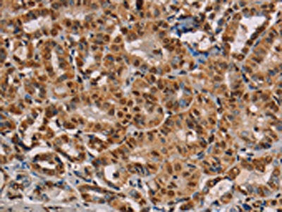 The image on the left is immunohistochemistry of paraffin-embedded Human thyroid cancer tissue using CSB-PA948825(RBMX Antibody) at dilution 1/45, on the right is treated with fusion protein. (Original magnification: ×200)