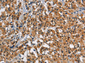 The image on the left is immunohistochemistry of paraffin-embedded Human thyroid cancer tissue using CSB-PA948873(SMAD9 Antibody) at dilution 1/30, on the right is treated with synthetic peptide. (Original magnification: ×200)