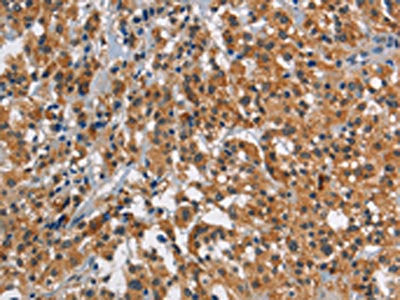 The image on the left is immunohistochemistry of paraffin-embedded Human thyroid cancer tissue using CSB-PA948873(SMAD9 Antibody) at dilution 1/30, on the right is treated with synthetic peptide. (Original magnification: ×200)