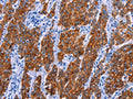 The image on the left is immunohistochemistry of paraffin-embedded Human gastic cancer tissue using CSB-PA949280(NR4A2 Antibody) at dilution 1/20, on the right is treated with fusion protein. (Original magnification: ×200)