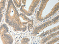 The image on the left is immunohistochemistry of paraffin-embedded Human colon cancer tissue using CSB-PA949361(MAP4K5 Antibody) at dilution 1/20, on the right is treated with fusion protein. (Original magnification: ×200)