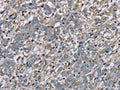 The image on the left is immunohistochemistry of paraffin-embedded Human liver cancer tissue using CSB-PA949422(FAP Antibody) at dilution 1/30, on the right is treated with fusion protein. (Original magnification: ×200)
