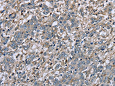 The image on the left is immunohistochemistry of paraffin-embedded Human liver cancer tissue using CSB-PA949422(FAP Antibody) at dilution 1/30, on the right is treated with fusion protein. (Original magnification: ×200)